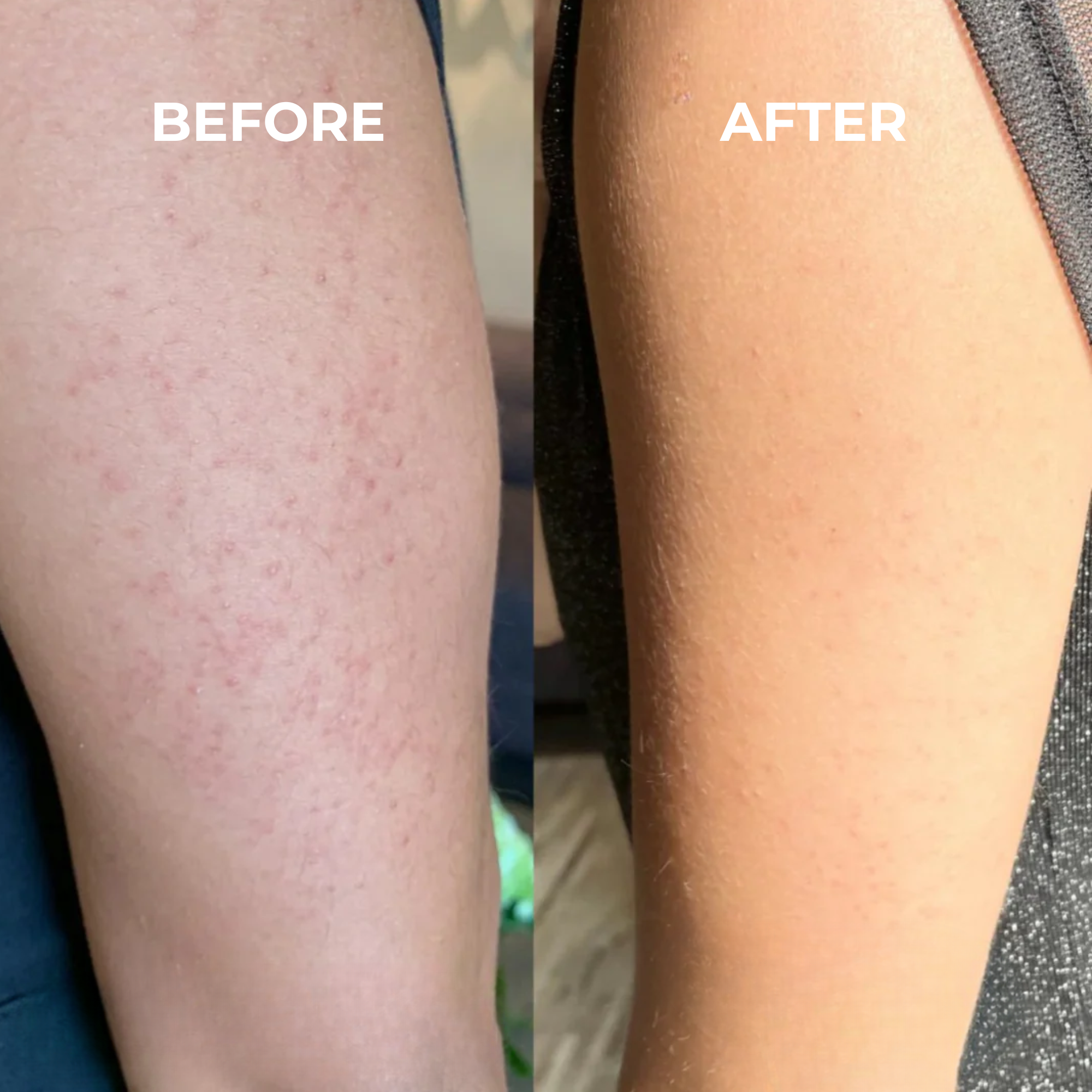 KERATOSIS PILARIS SMOOTHING CREAM