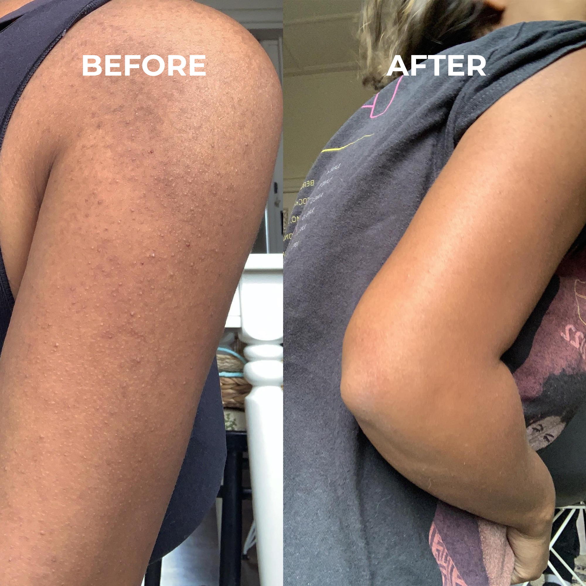 KERATOSIS PILARIS SMOOTHING CREAM