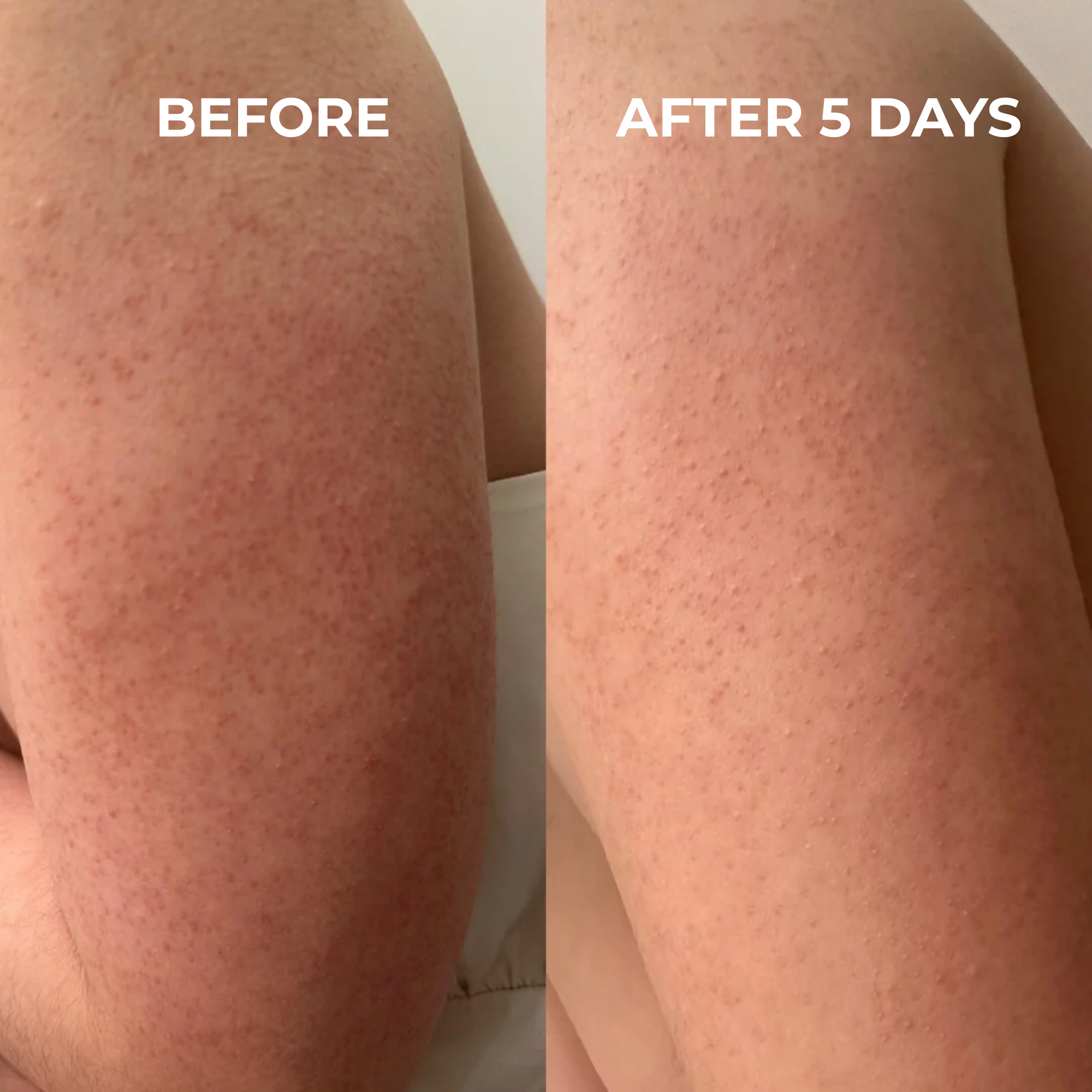 Keratosis Pilaris Smoothing Cream
