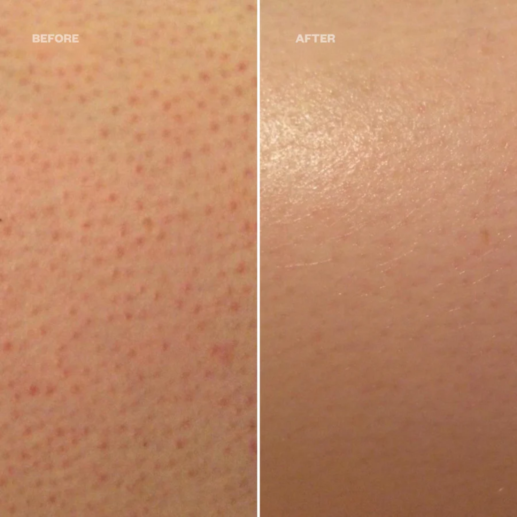 Keratosis Pilaris Smoothing Cream